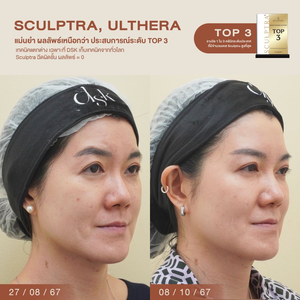 HN.B67-001362_ulthera