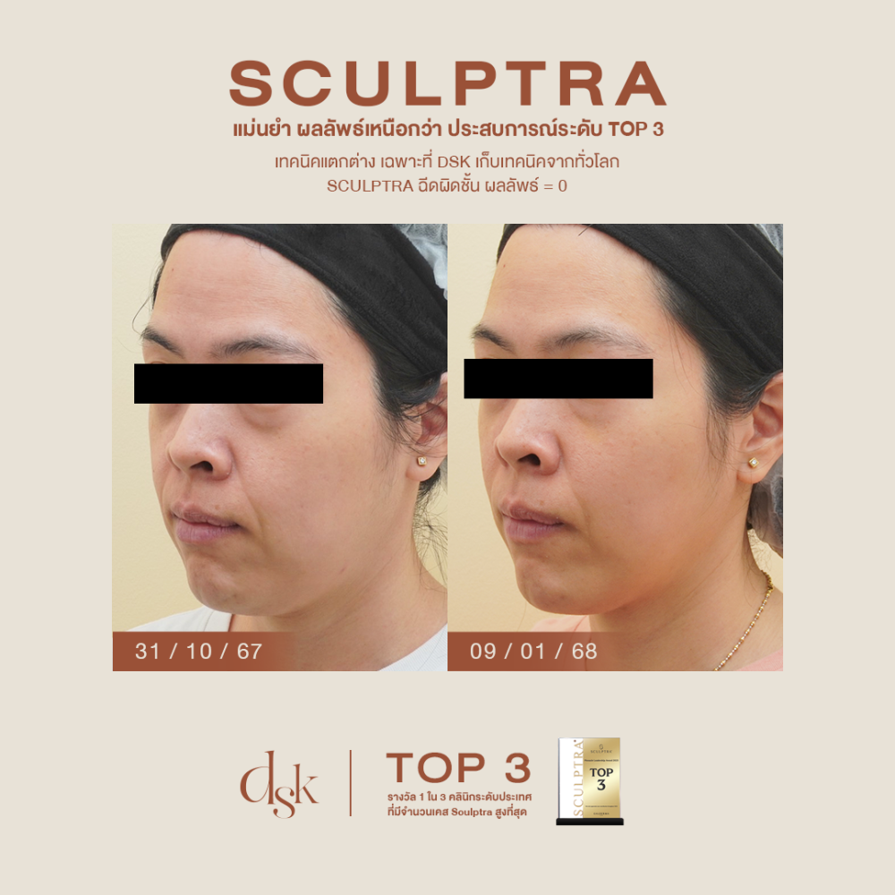 HN.B67-001520_sculptra_