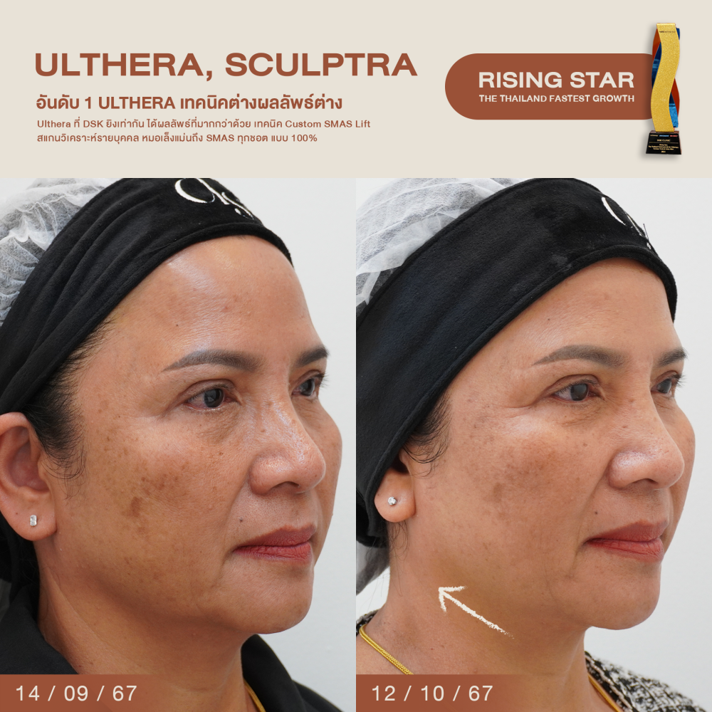 HN.P67-000051_Ulthera,sculptra