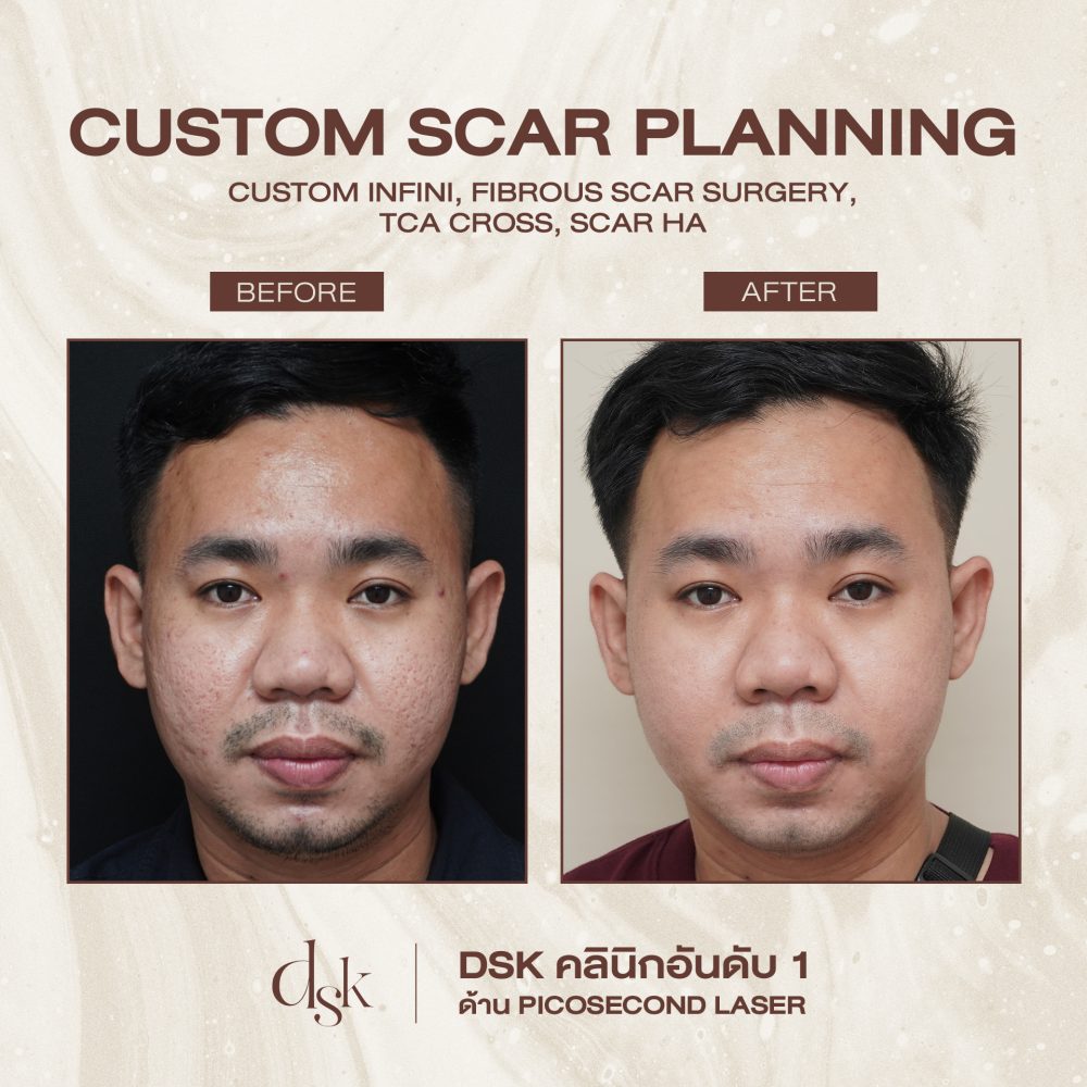 HN.R64-000009_CUSTOM SCAR