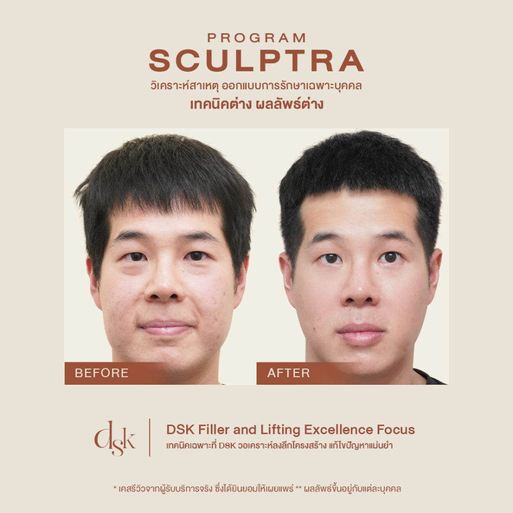 HN.R65-015689_Sculptra