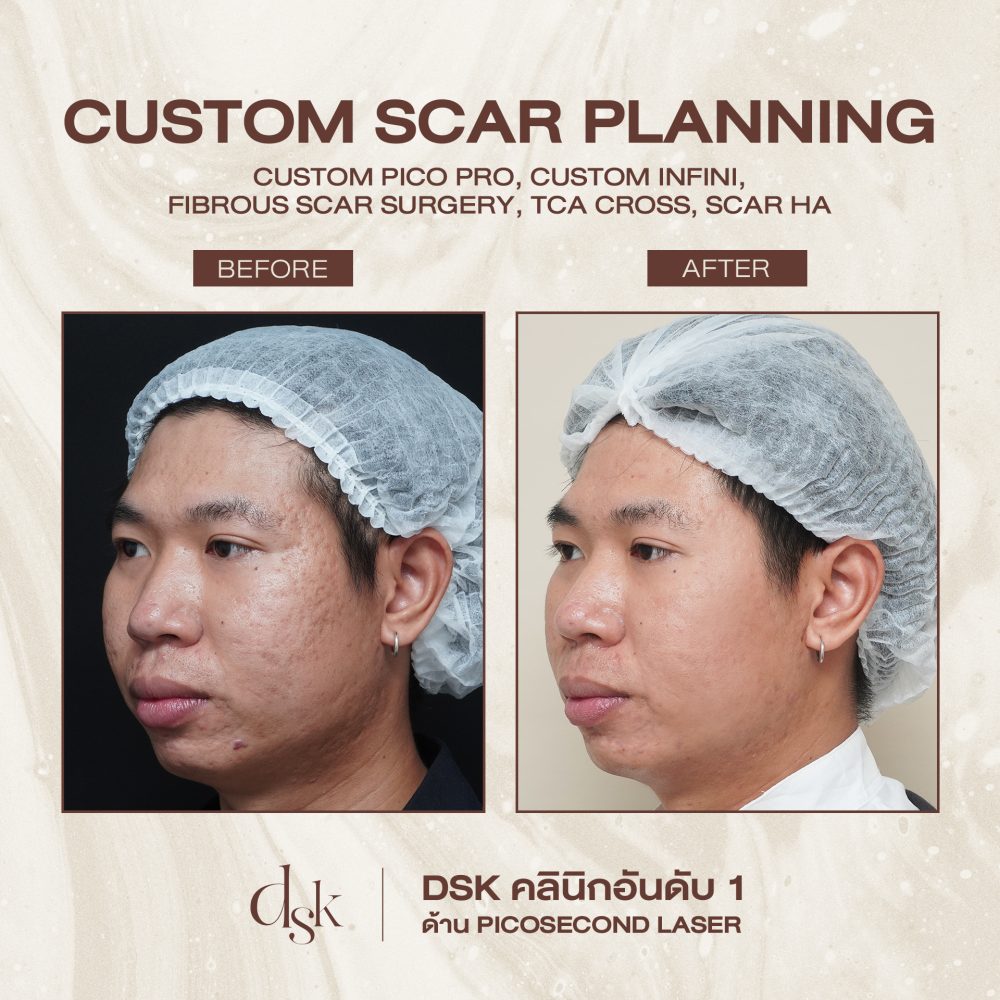 HN.R65-015704_CUSTOM SCAR