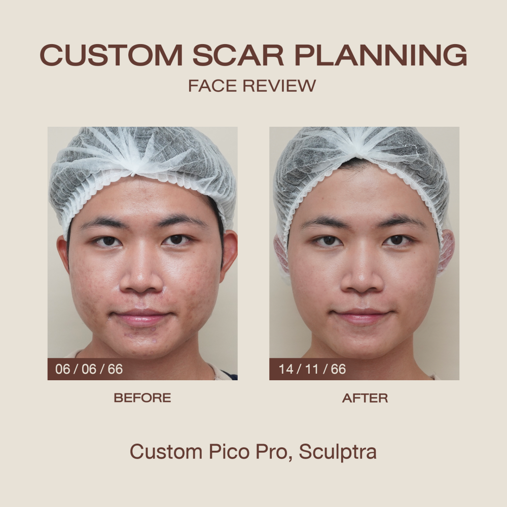 HN.R65-017058_ Custom Scar planing