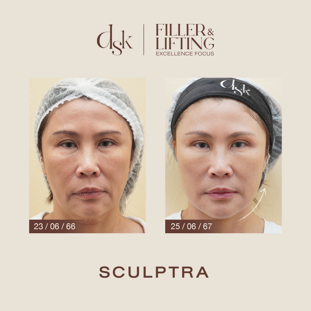 HN.S66-000804_sculptra