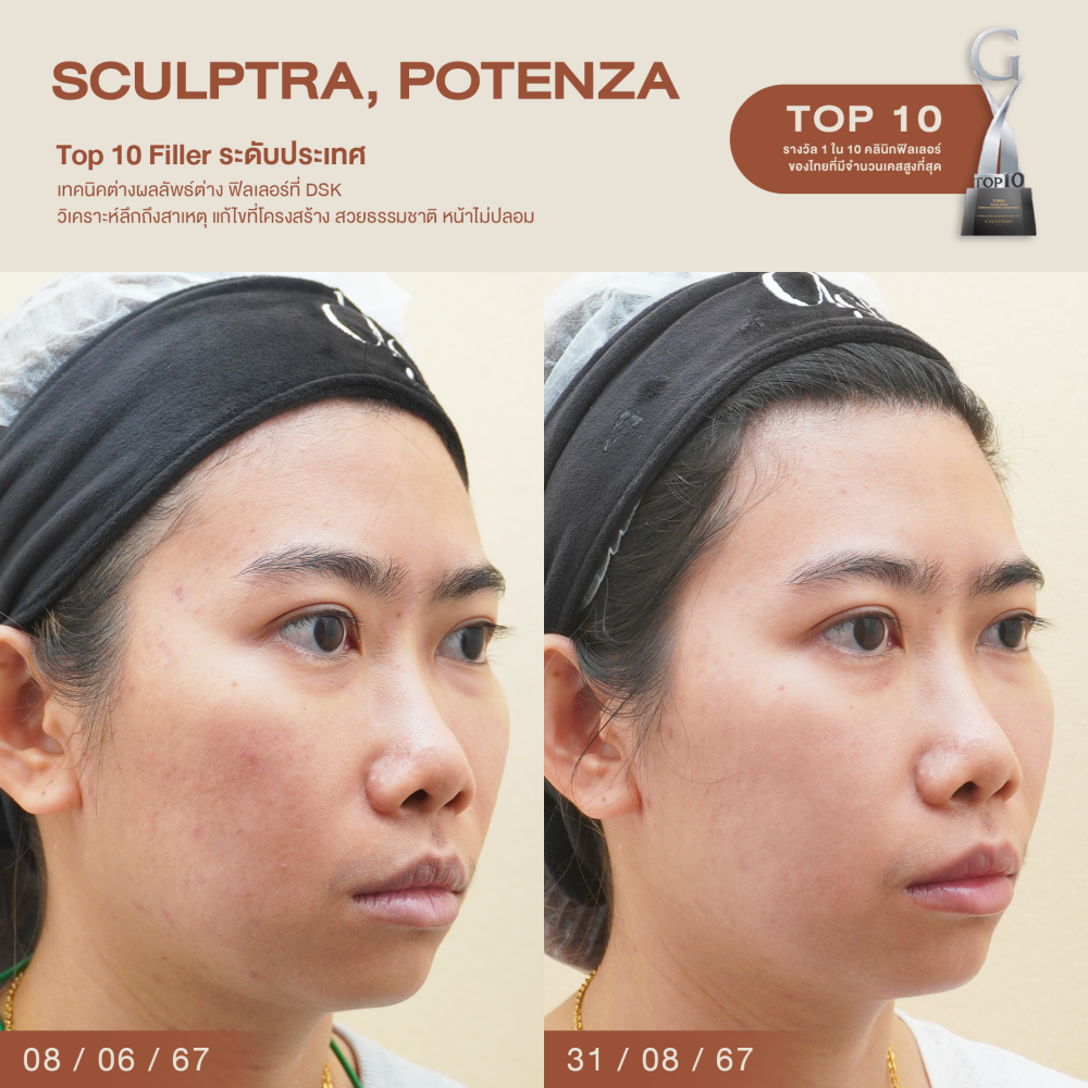 HN.S66-001213_Potenza,sculptra3 shot