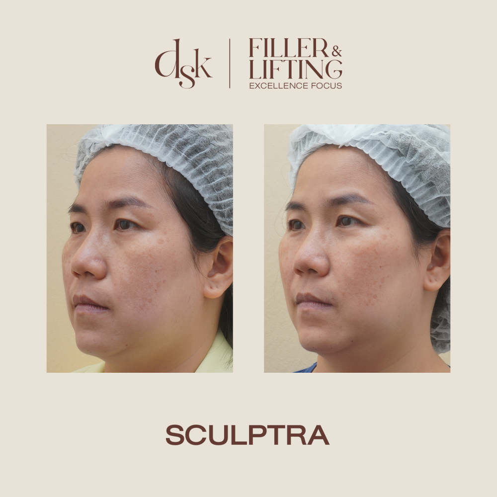 HN.S67-001560_Sculptra_dr.porsche