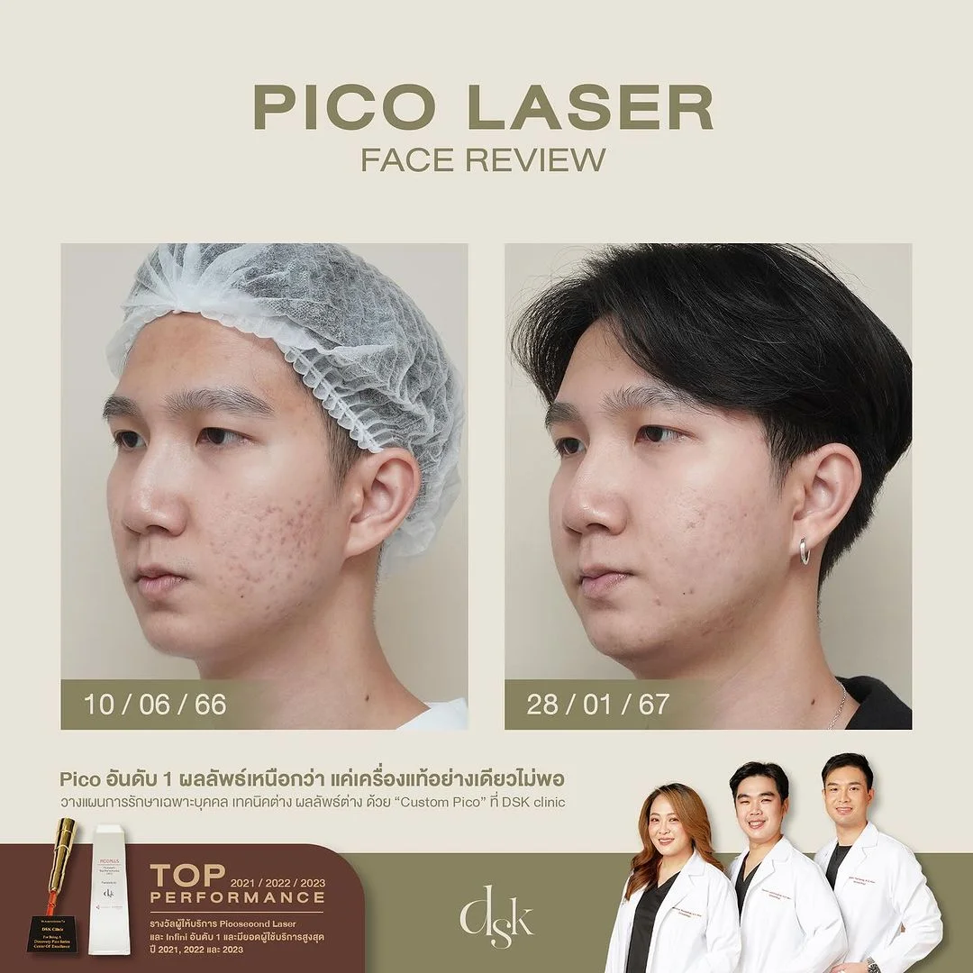 รีวิวเลเซอร์รอยสิว Pico Laser 1