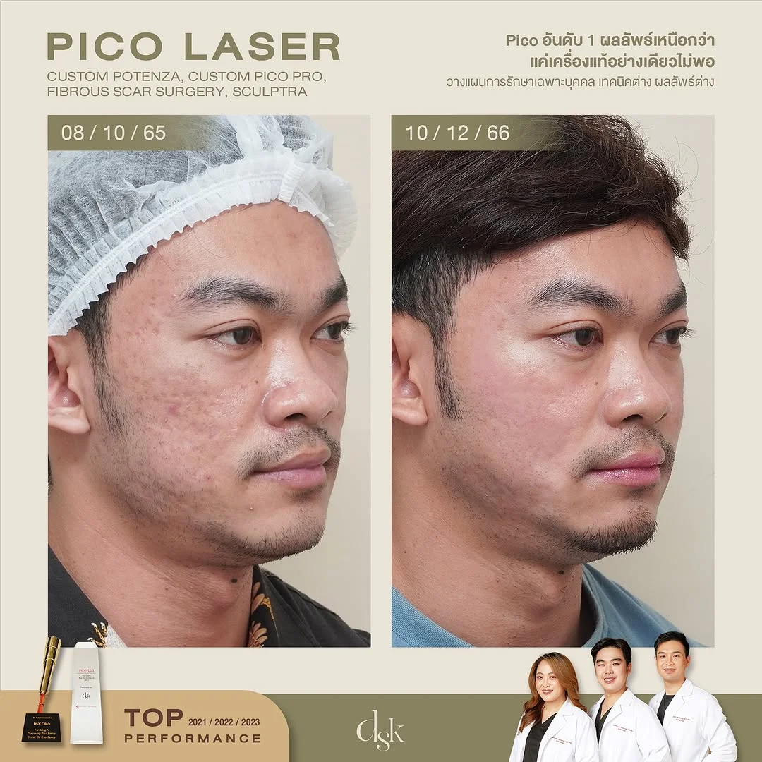 รีวิวเลเซอร์รอยสิว Pico Laser 2