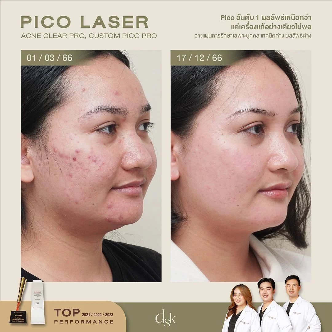 รีวิวเลเซอร์รอยสิว Pico Laser 3