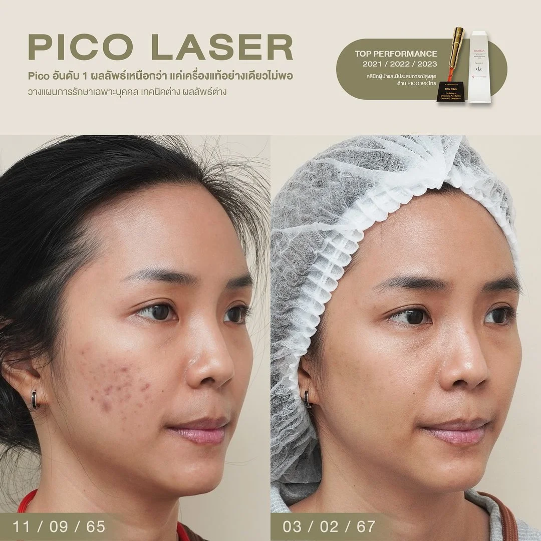 รีวิวเลเซอร์รอยสิว Pico Laser 4