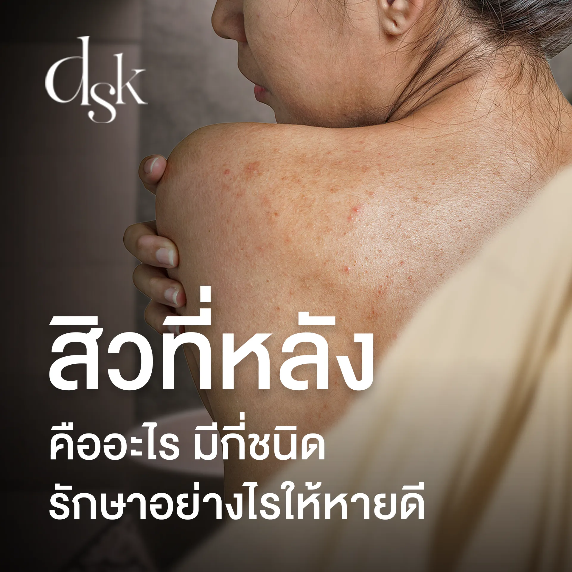 สิวที่หลัง