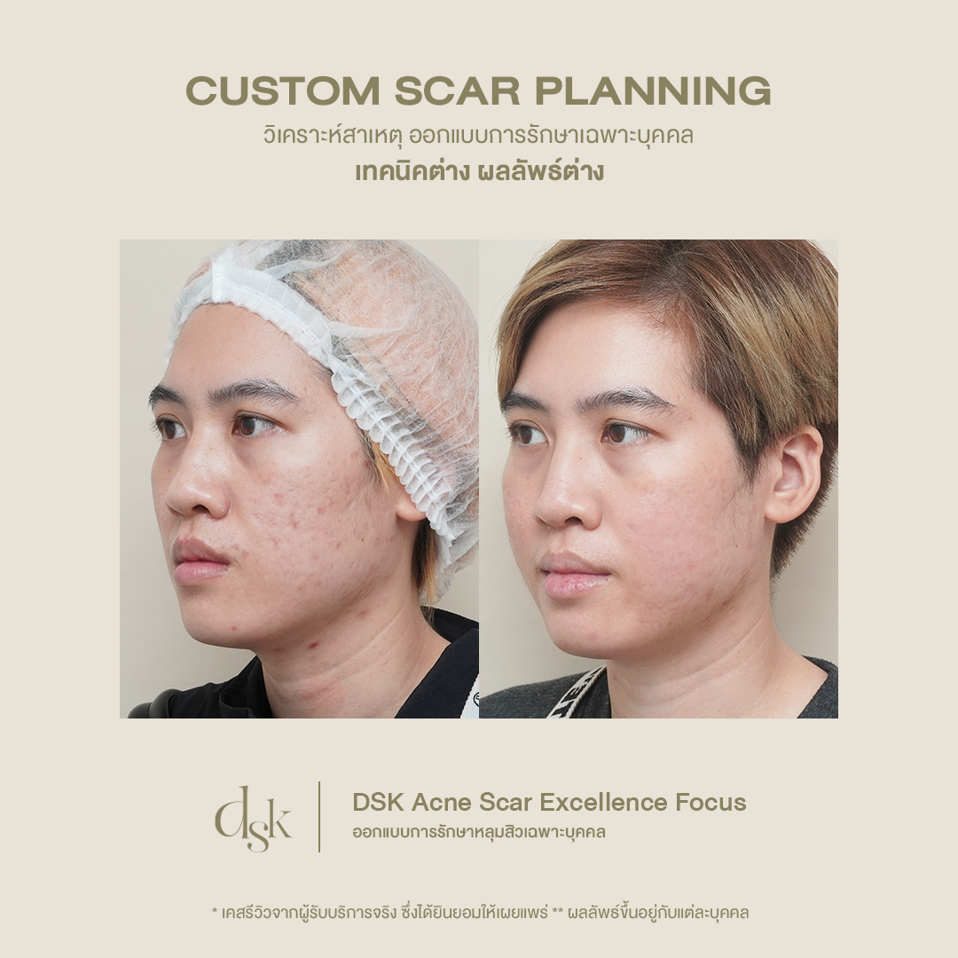 รีวิวผลลัพธ์หลังทำโปรแกรม Pico Laser 