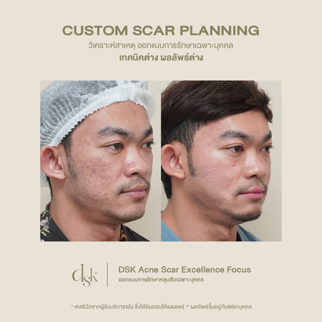 รีวิวผลลัพธ์หลังทำโปรแกรม Pico Laser 