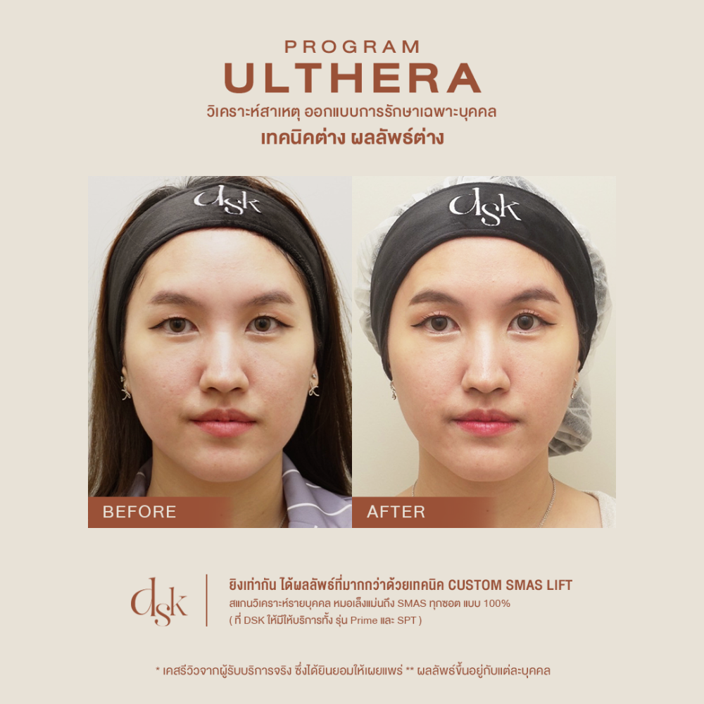 B_A ULTHERA 03 done (1)