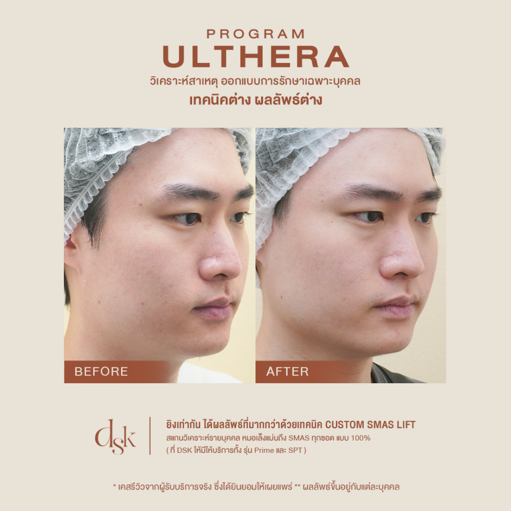 B_A ULTHERA 05 Done (1)