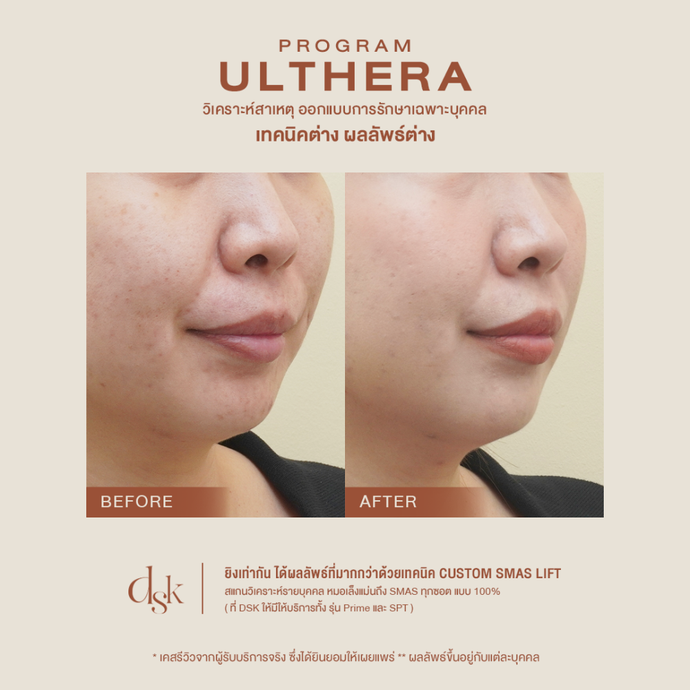 B_A ULTHERA 07 done (1)