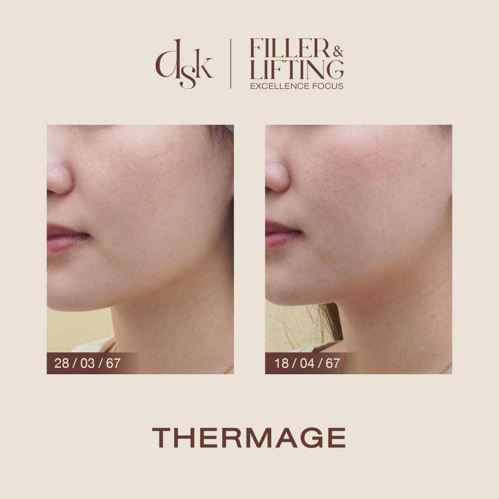 HN.B67-001133_Thermage_Dr.sai