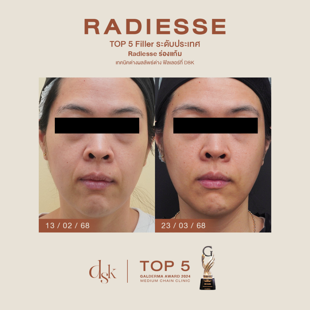 HN.B67-001520_Radiesse_dr.gift