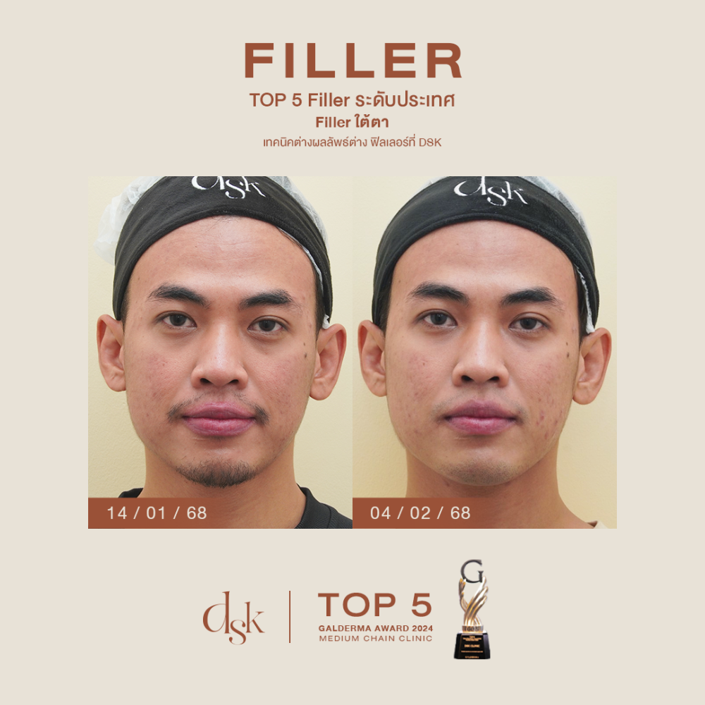 HN.B68-001702_Filler ใต้ตา Dr.prince