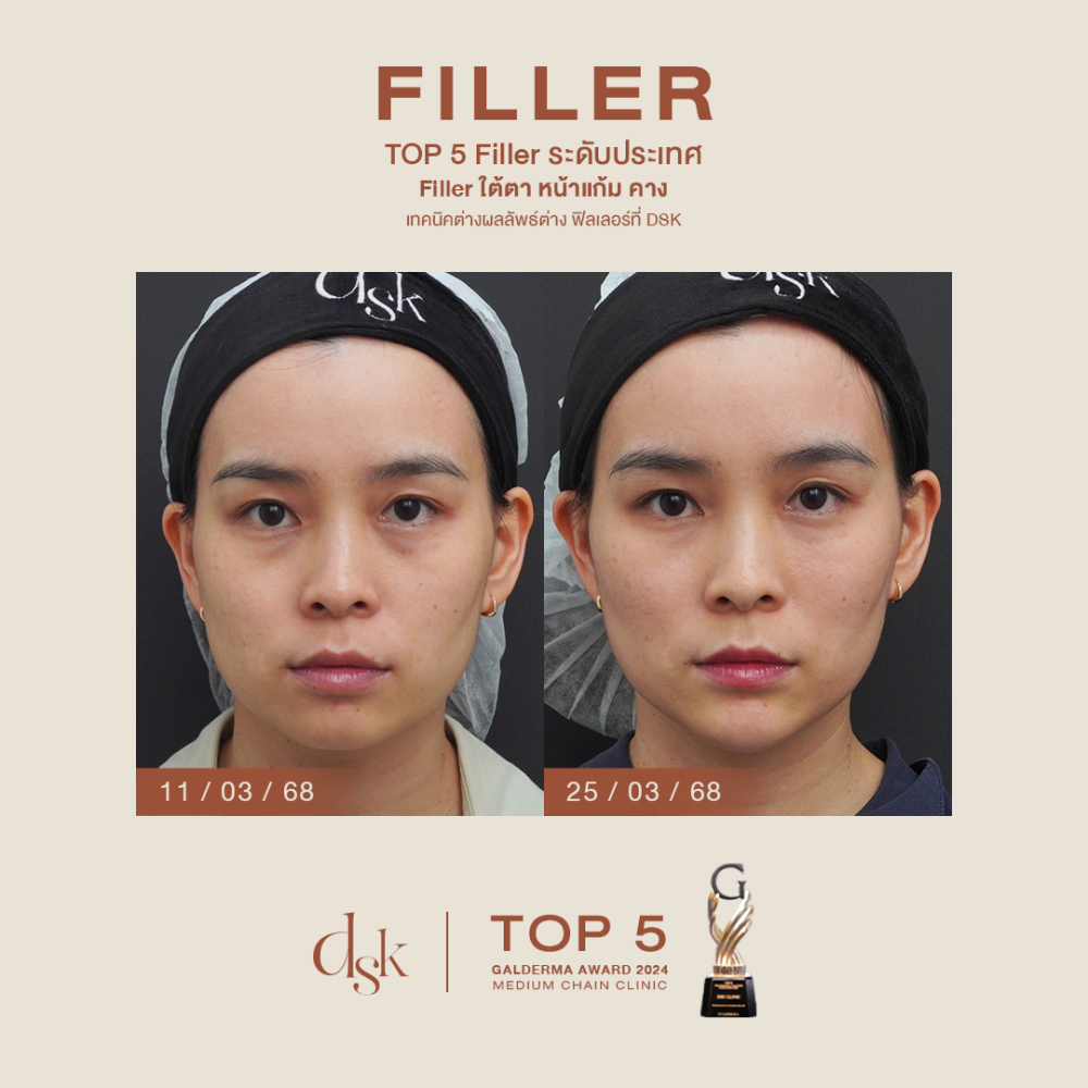 HN.B68-001803_fillerใต้ตาหน้าแก้มคาง _dr.prince