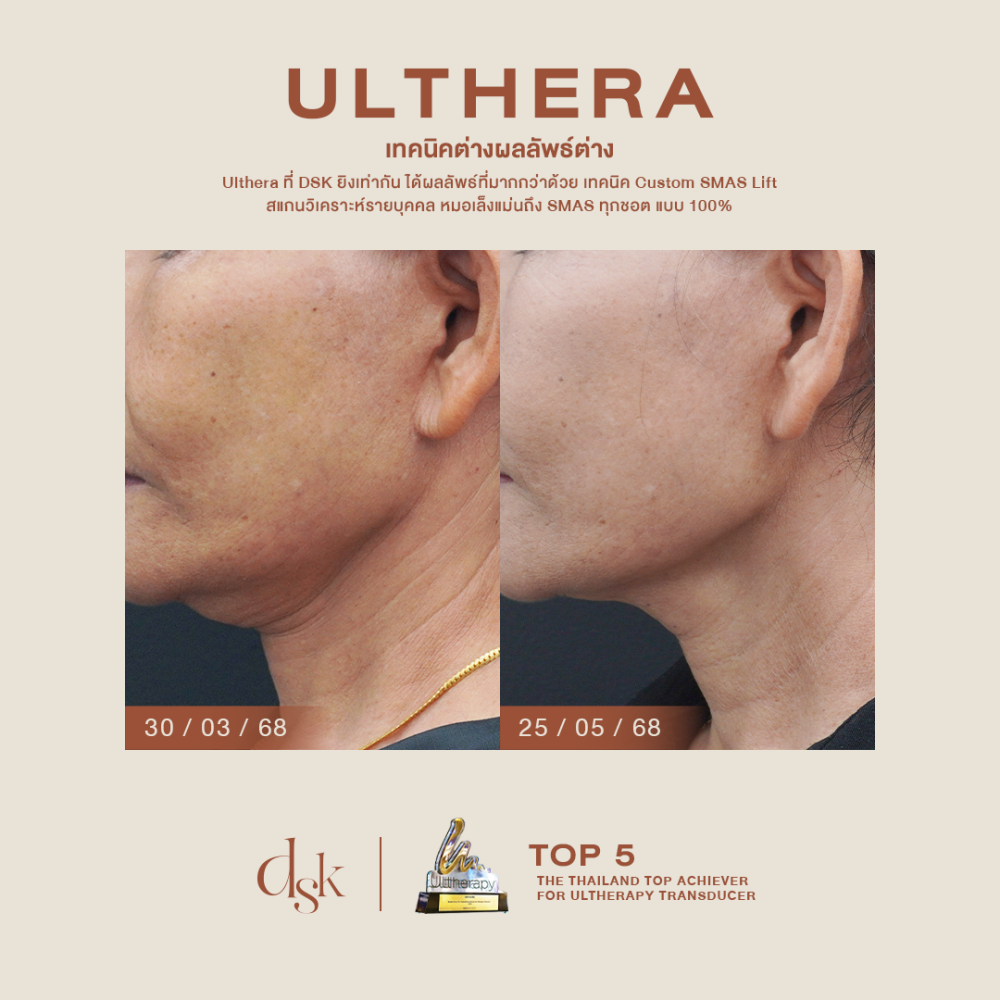 HN.B68-001857_ulthera_drgift