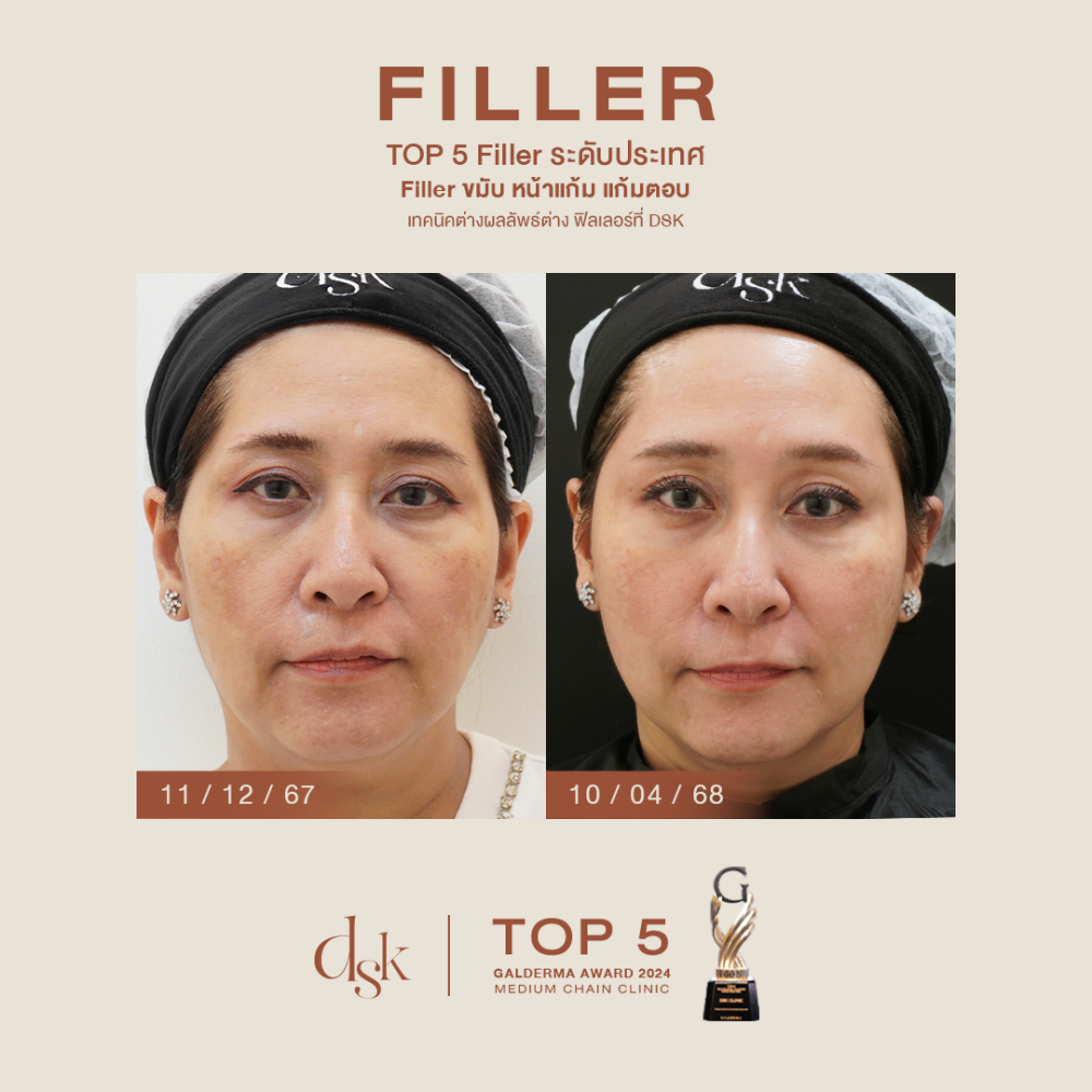 HN.P67-000040_filler ขมับหน้าแก้มแก้มตอบ_dr.prince