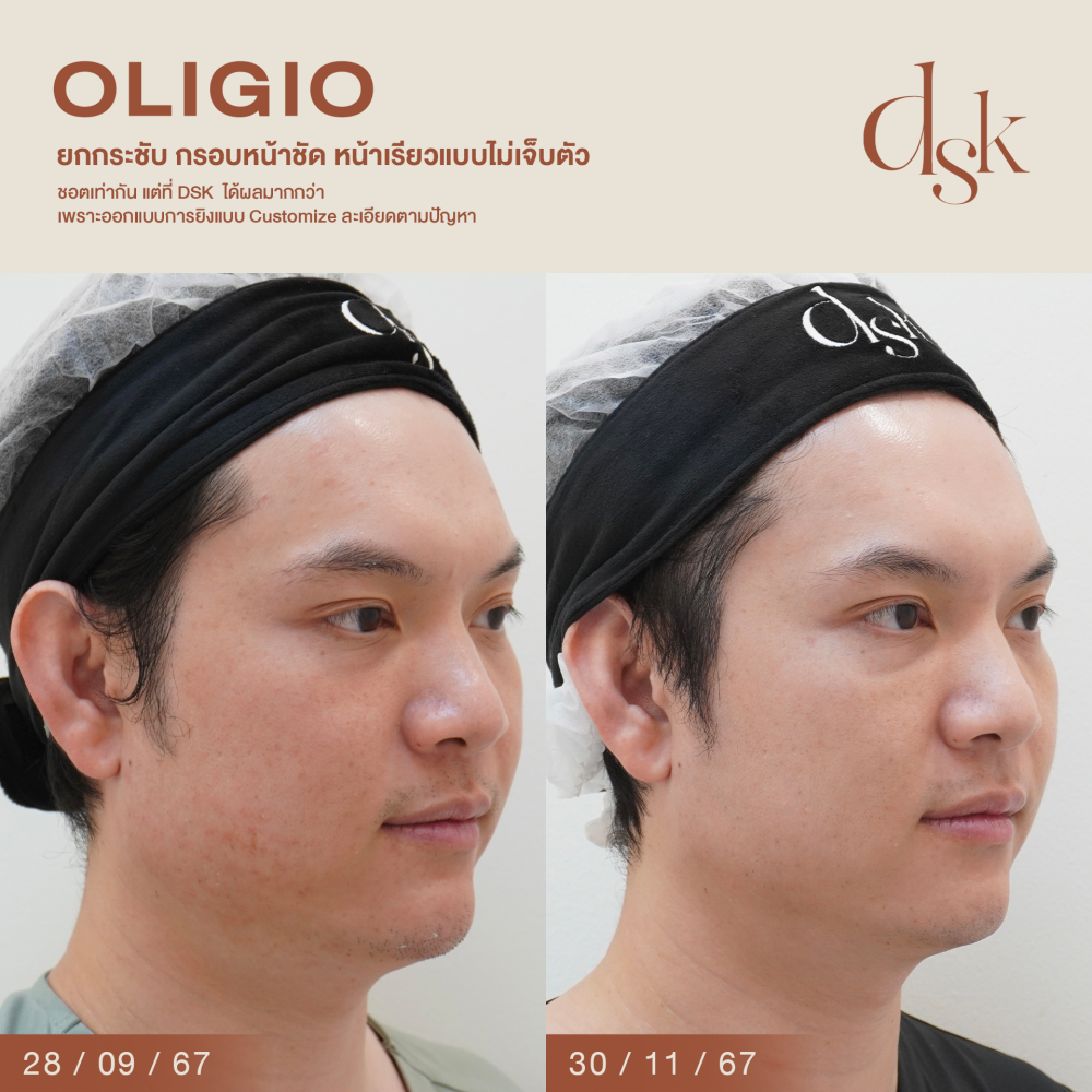 HN.P67-000129_oligio _300shot