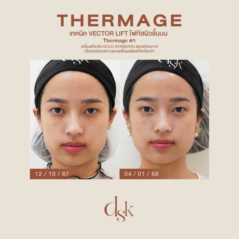 HN.P67-000133_THermage ตา_dr.kew_