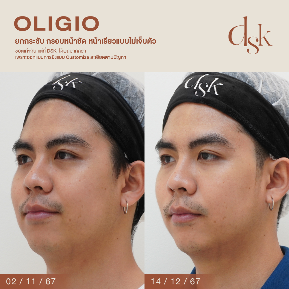 HN.P67-000202_oligio_dr.kew