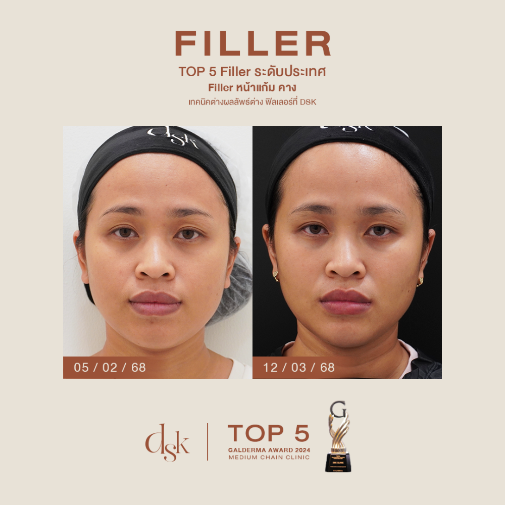 HN.P67-000344_filler หน้าแก้ม คาง_dr.prince