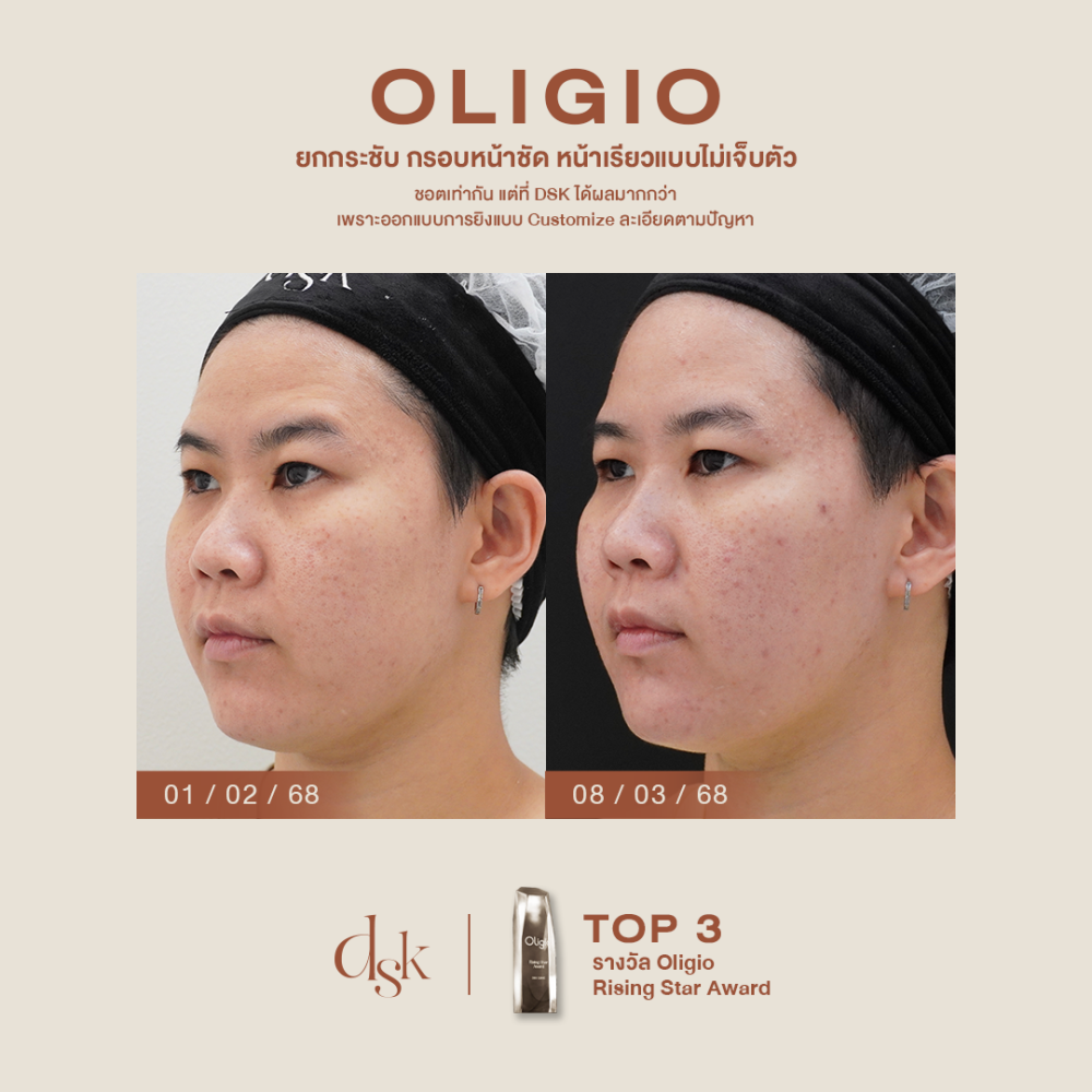 HN.P68-000395_oligio_dr.kew