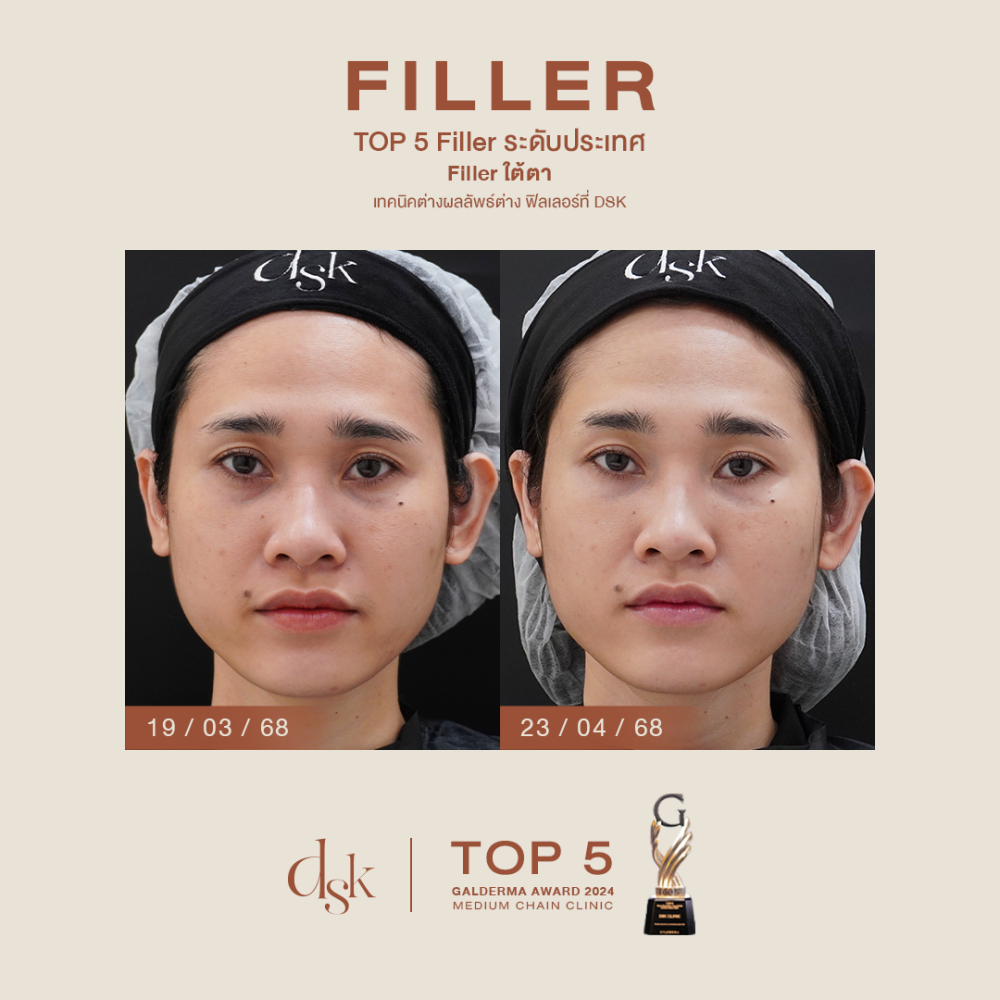 HN.P68-000516_Filler ใต้ตา_dr.prince