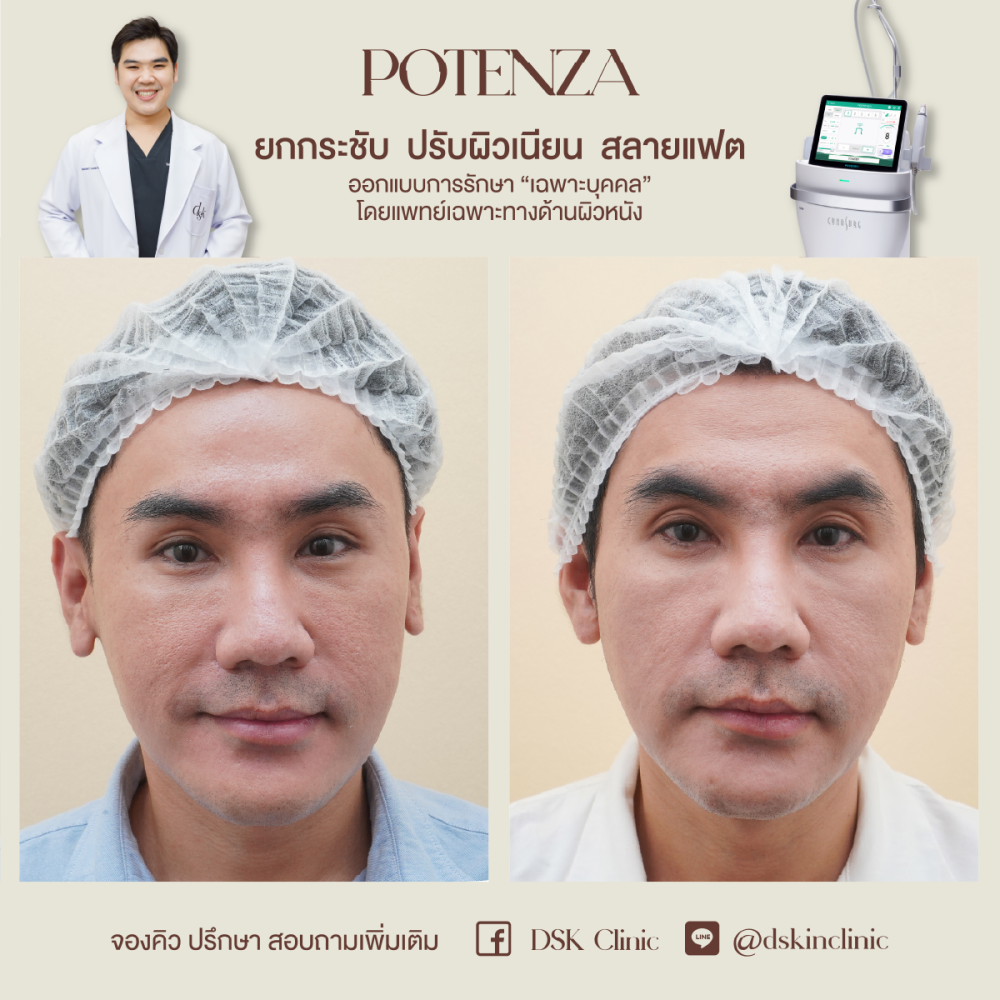 HN.R65-015914_Potenza_ยกกระชับ