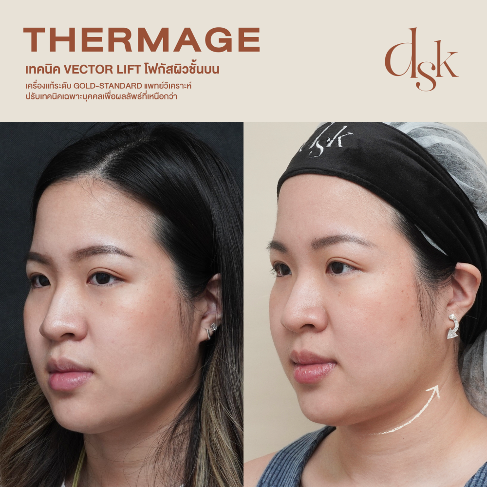 HN.R65-016132_thermage_45