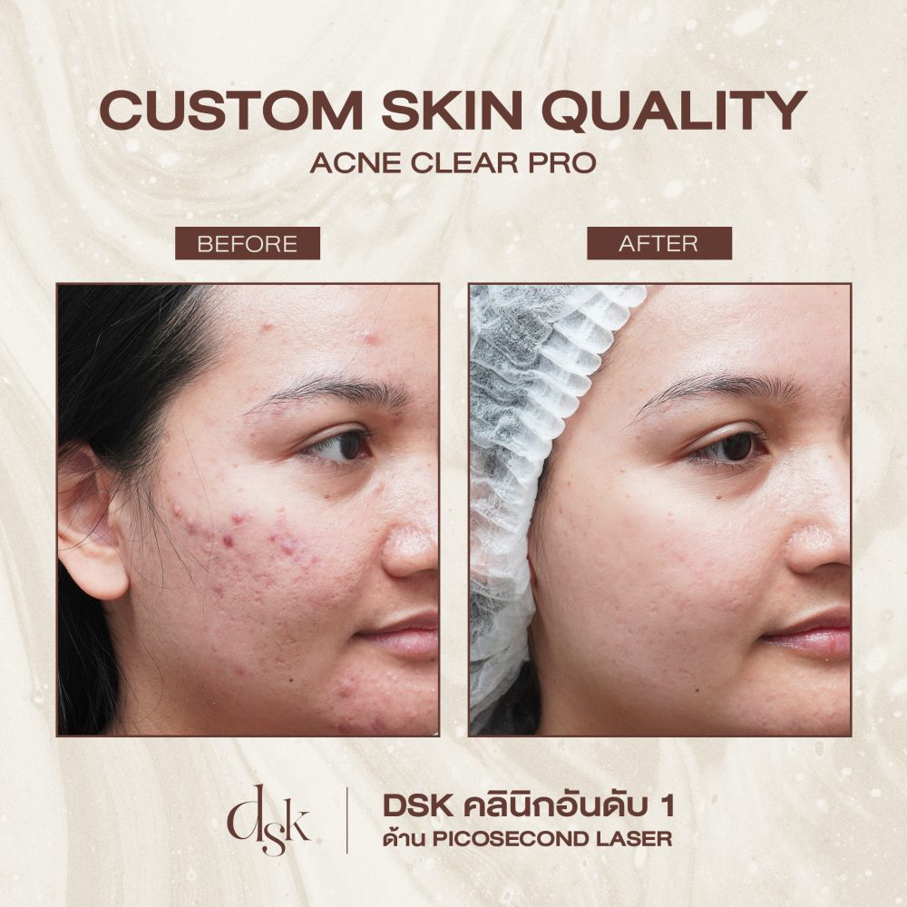 HN.R66-017687_Acne Pro