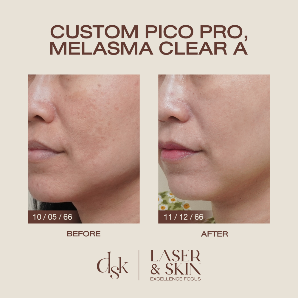 HN.R66-017931_pico+melasma