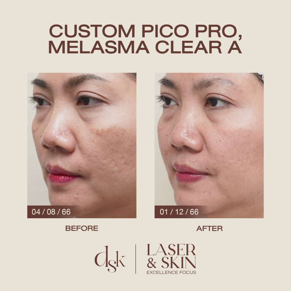 HN.R66-018150_pico+melasma