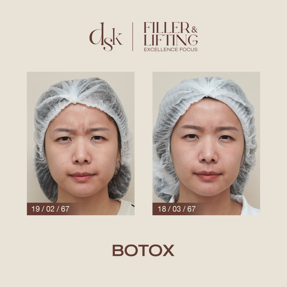 HN.R67-018638_botox_dr.nan_หว่างคิ้ว