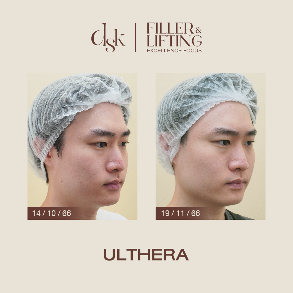 HN.S65-000028_Ulthera_dr.porsche