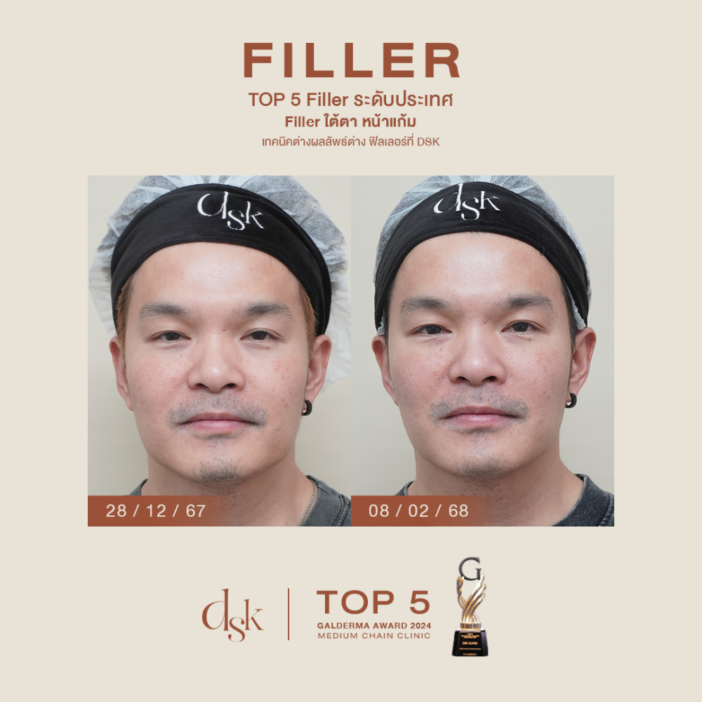 HN.S67-001700_fillerใต้ตาหน้าแก้ม_dr.gift