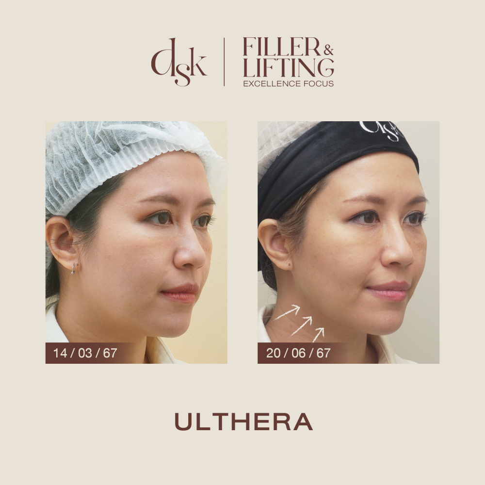 HN.S67-001702_ulthera