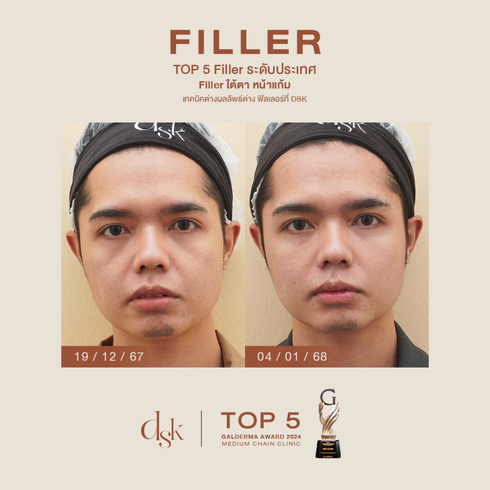 HN.S67-002406_Filler ใต้ตา หน้าแก้ม_Dr.prince