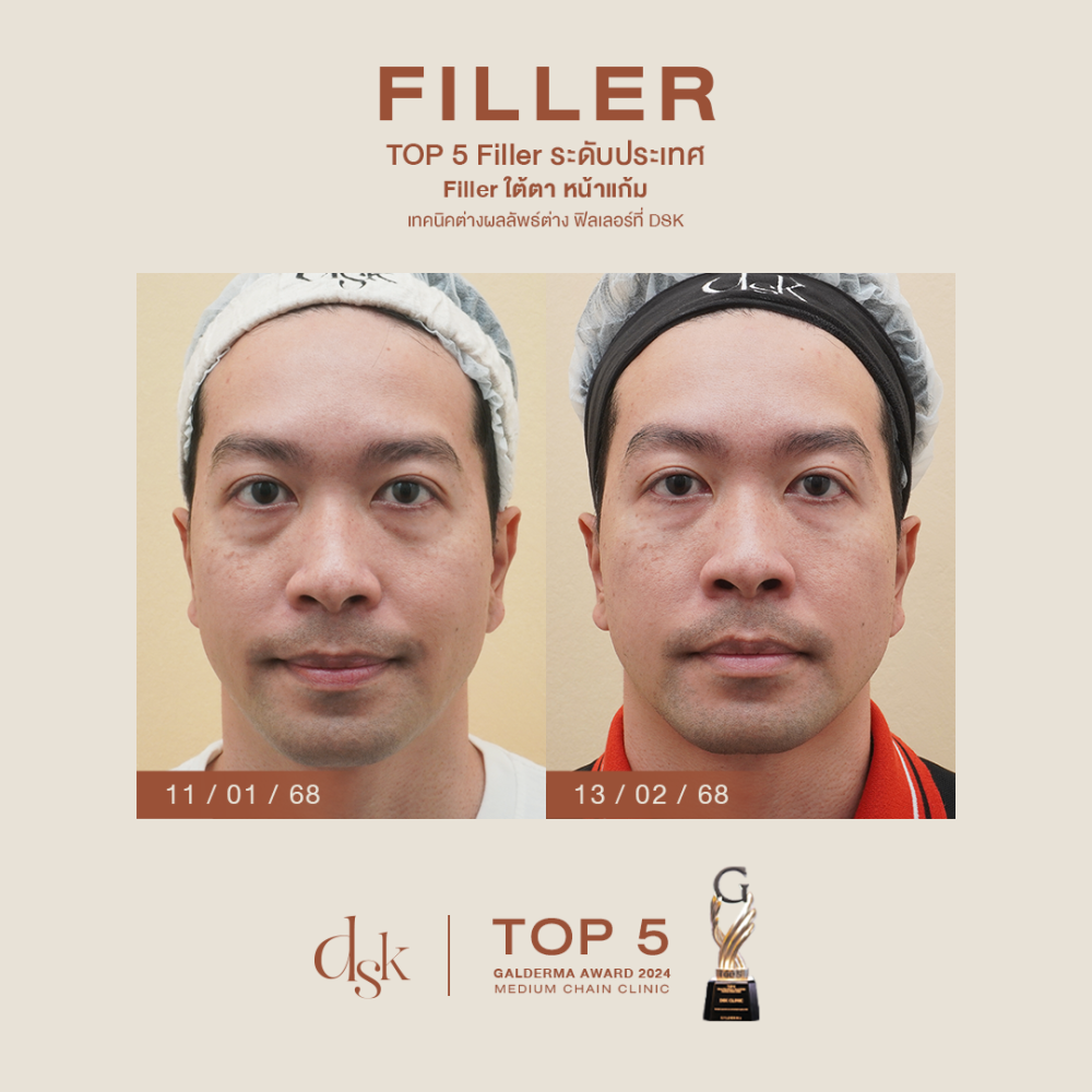 HN.S67-002422_filler ใต้ตา หน้าแก้ม _Dr.prince_