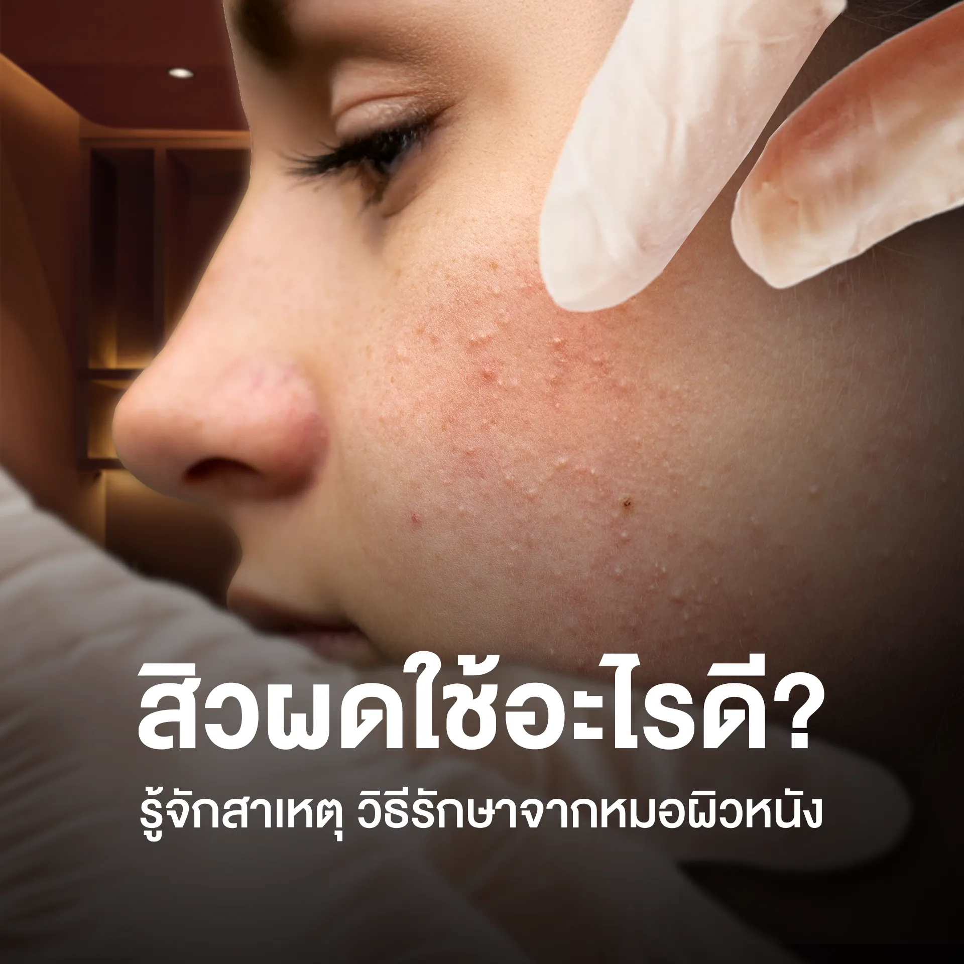 สิวผด
