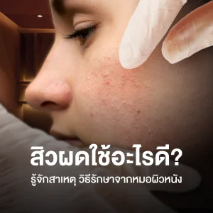 สิวผด