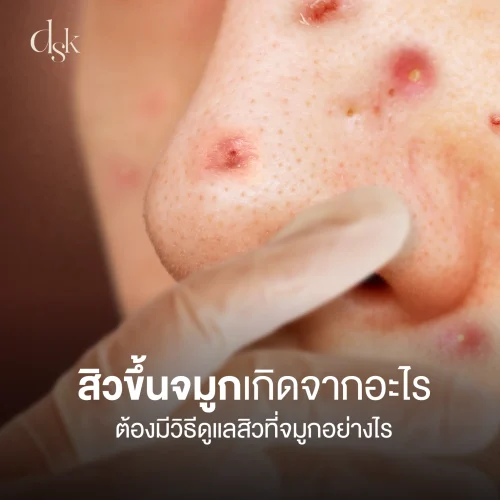 สิวขึ้นจมูกเกิดจากอะไร ต้องมีวิธีดูแลสิวที่จมูกอย่างไร