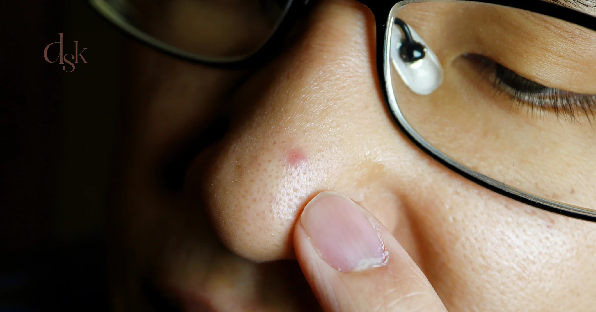 ประเภทสิวที่จมูก