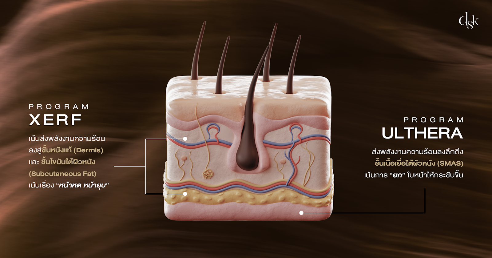 XERF กับ Ulthera จุดเด่น