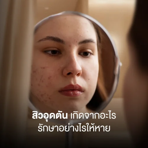 สิวอุดตัน เกิดจากอะไร รักษาอย่างไรให้หาย ไม่กลับมาเป็นซ้ำ