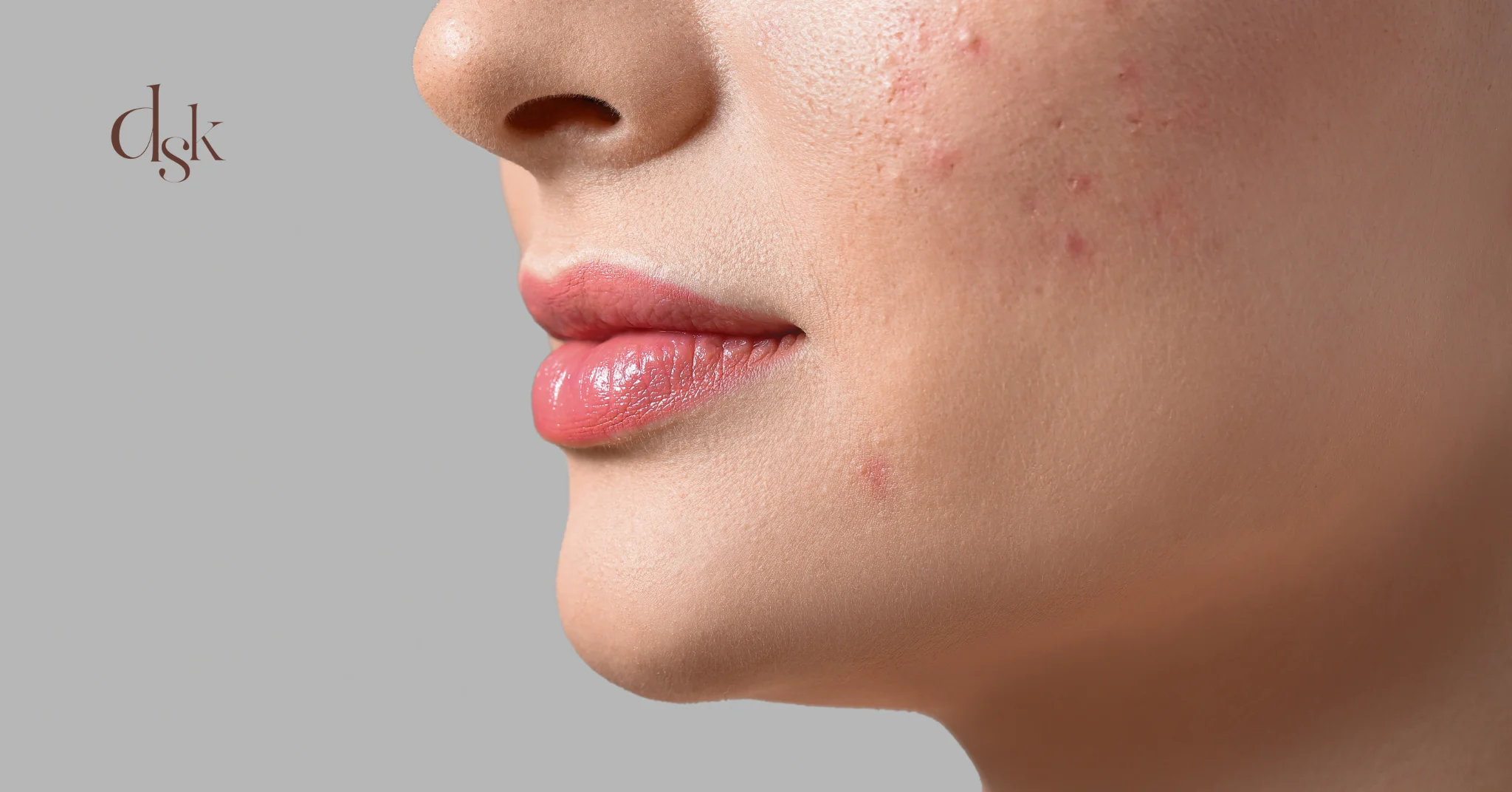 สิวอุดตันมีลักษณะอย่างไร